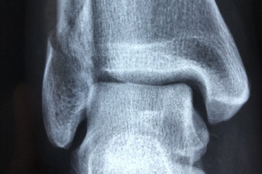 Форма коленной чашечки может указывать на риск развития остеоартрита у человека