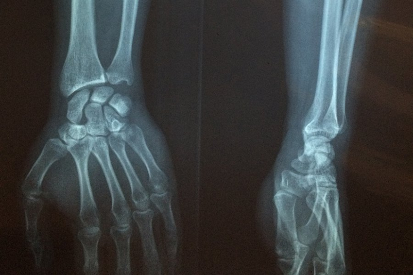 Древние вирусные элементы в РНК запускают процесс восстановления костей